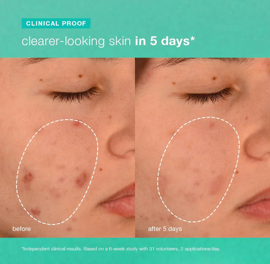 breakout biotic moisturizer