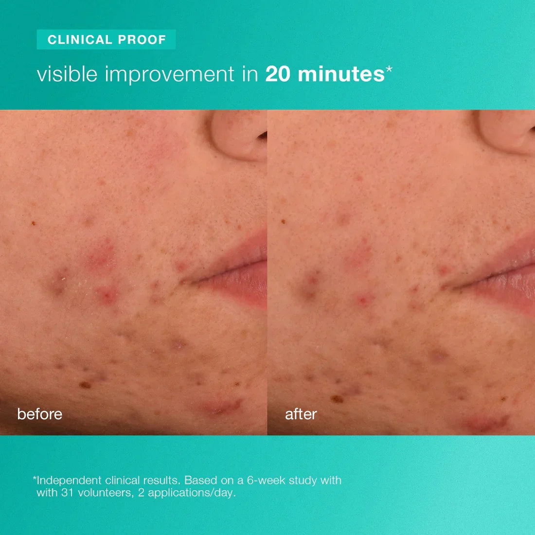 pelembap breakout biotik 7ml (bernilai RM59)