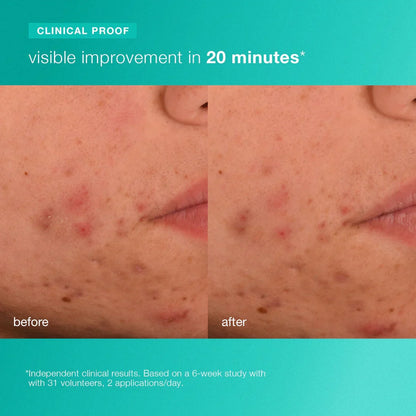 pelembap breakout biotik 7ml (bernilai RM59)